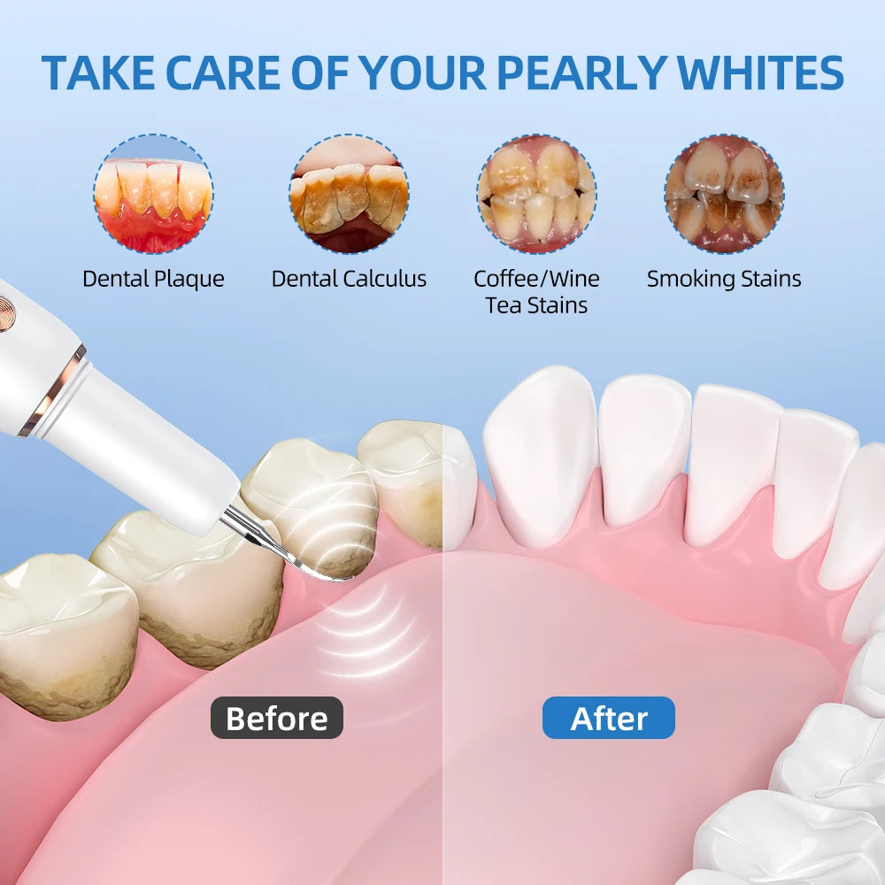 Ultrasonic Dental Cleaner